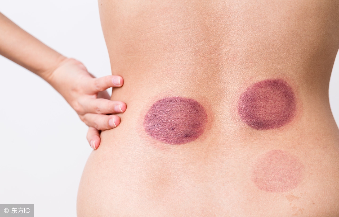 中医拔罐需要注意什么,中医拔罐的正确操作步骤