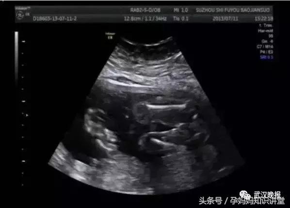 怀了双胞胎只生了一个怎么回事,怀孕双胞胎只生一个真相是什么