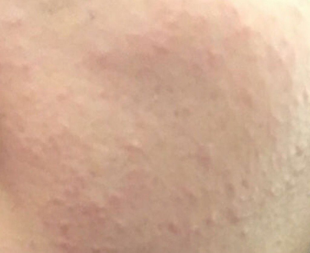 闭口粉刺最快的解决方法,闭口粉刺怎么去除不留疤痕