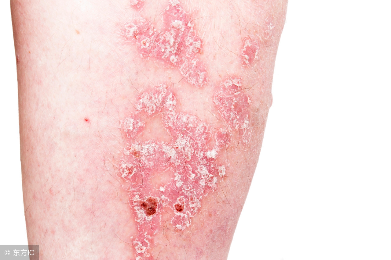 尖锐湿疣怎么来的，具体的病因是什么