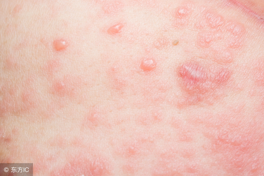 尖锐湿疣怎么来的，具体的病因是什么