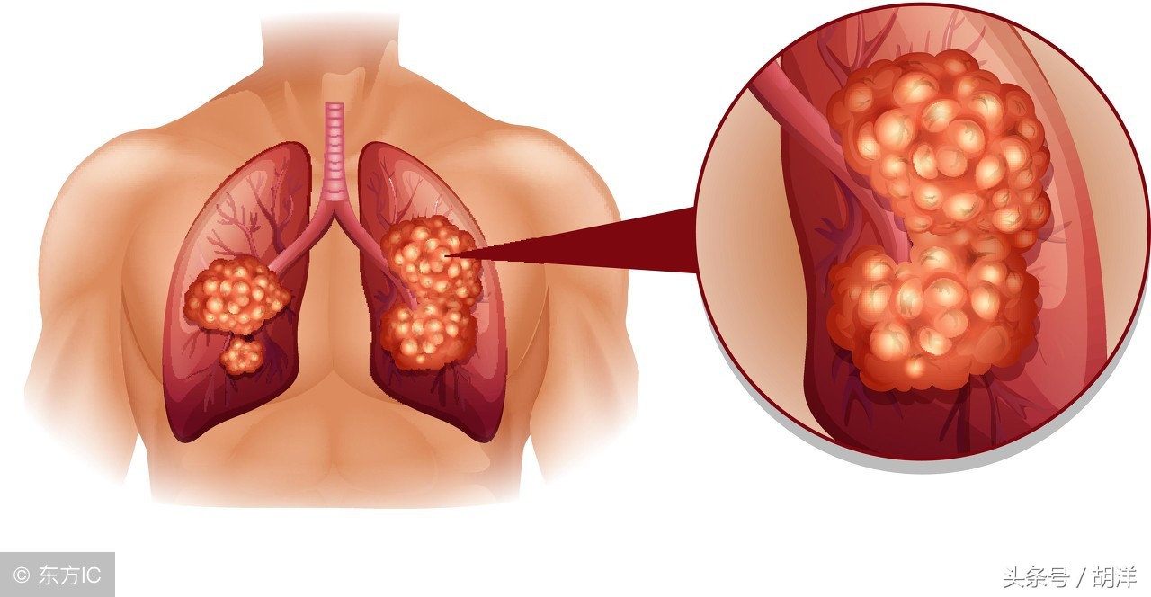 肺癌转移还能活多久，我的一些病人已活过9年，他们是怎么做到的