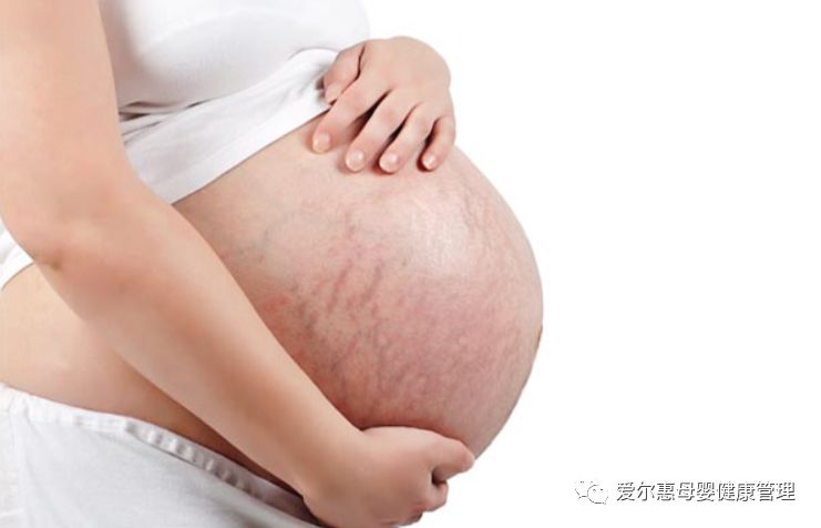 拒绝妊娠纹手法,拒绝怀孕措施