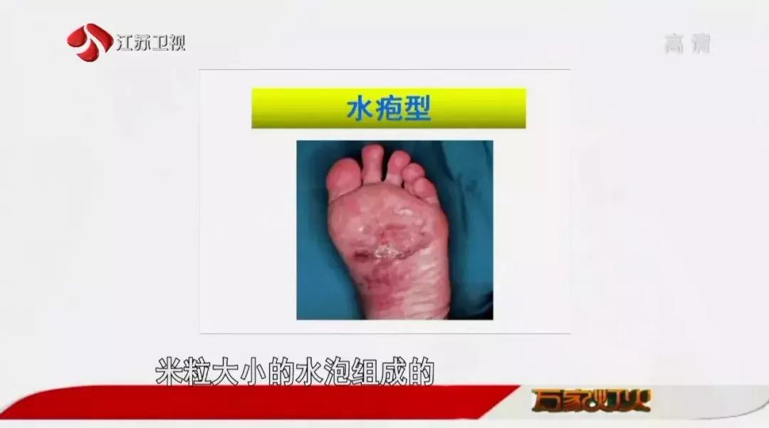 脚气反反复复怎么治疗,脚气反反复复发作怎么办