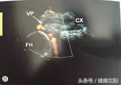 孕妈查出血管前置怎么办,孕期前置血管应注意什么