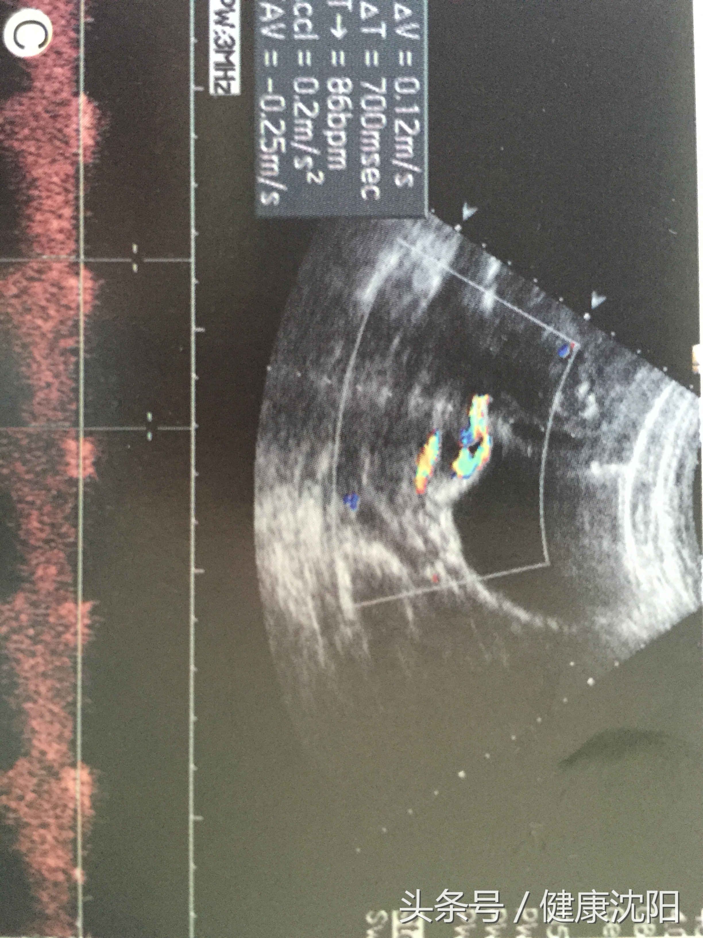 孕妈查出血管前置怎么办,孕期前置血管应注意什么
