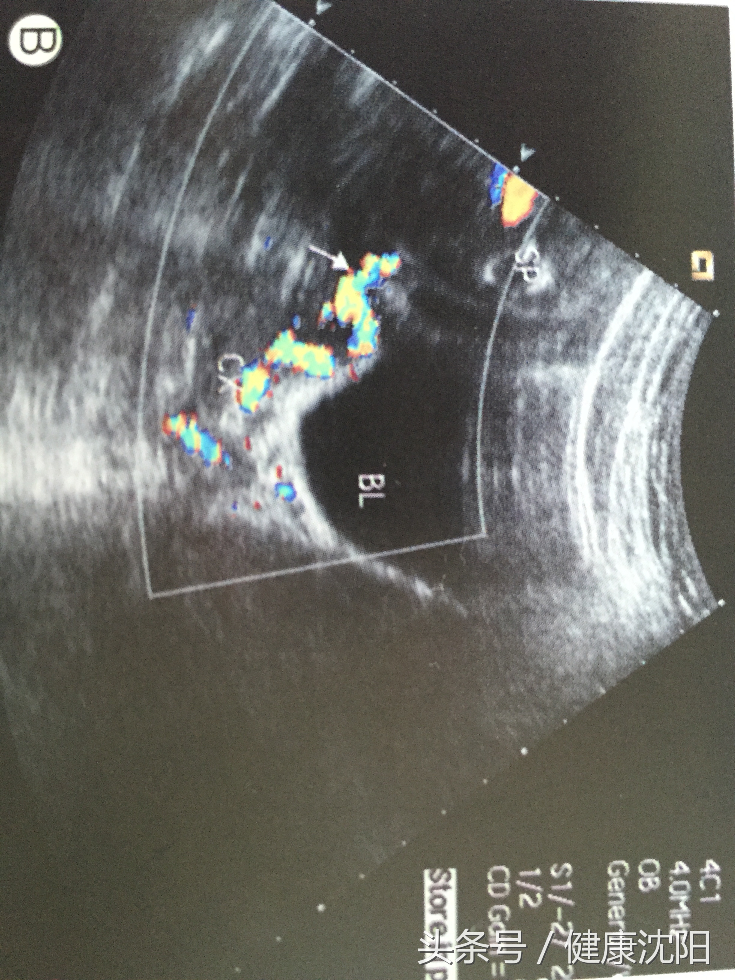 孕妈查出血管前置怎么办,孕期前置血管应注意什么