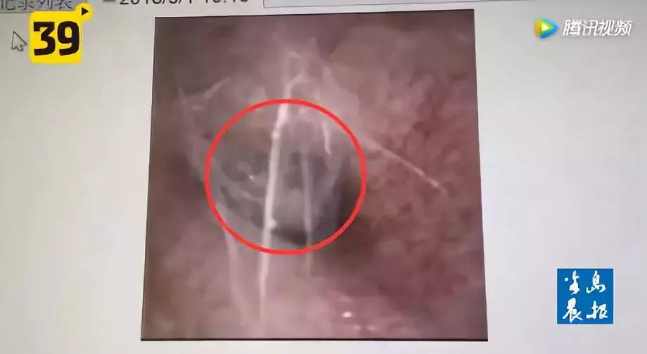 男子睡觉的时候耳朵里面出现异物,男子耳朵爬进了一只虫子