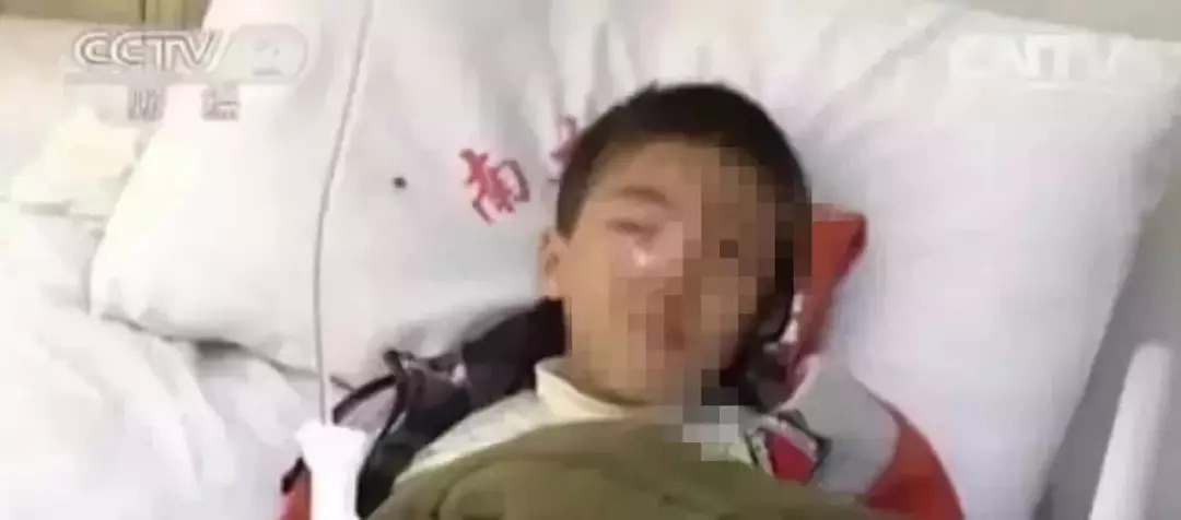 儿童眼球被溶化的原因,孩子眼球20分钟内被溶化