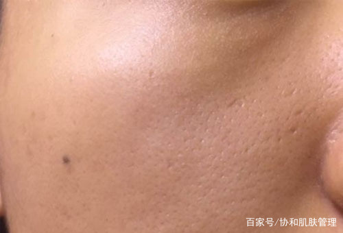 怎么有效的修复脸上的痘坑痘印,什么膏药能够治疗脸上的痘坑痘印