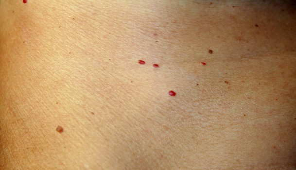 肝硬化的皮肤症状有哪些,肝硬化最怕的四种东西