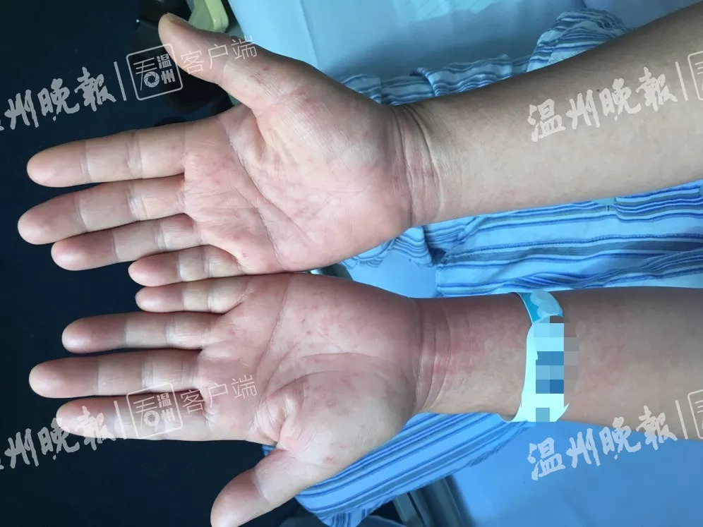 去泰国旅游后发高烧,泰国旅游回来得了罕见病