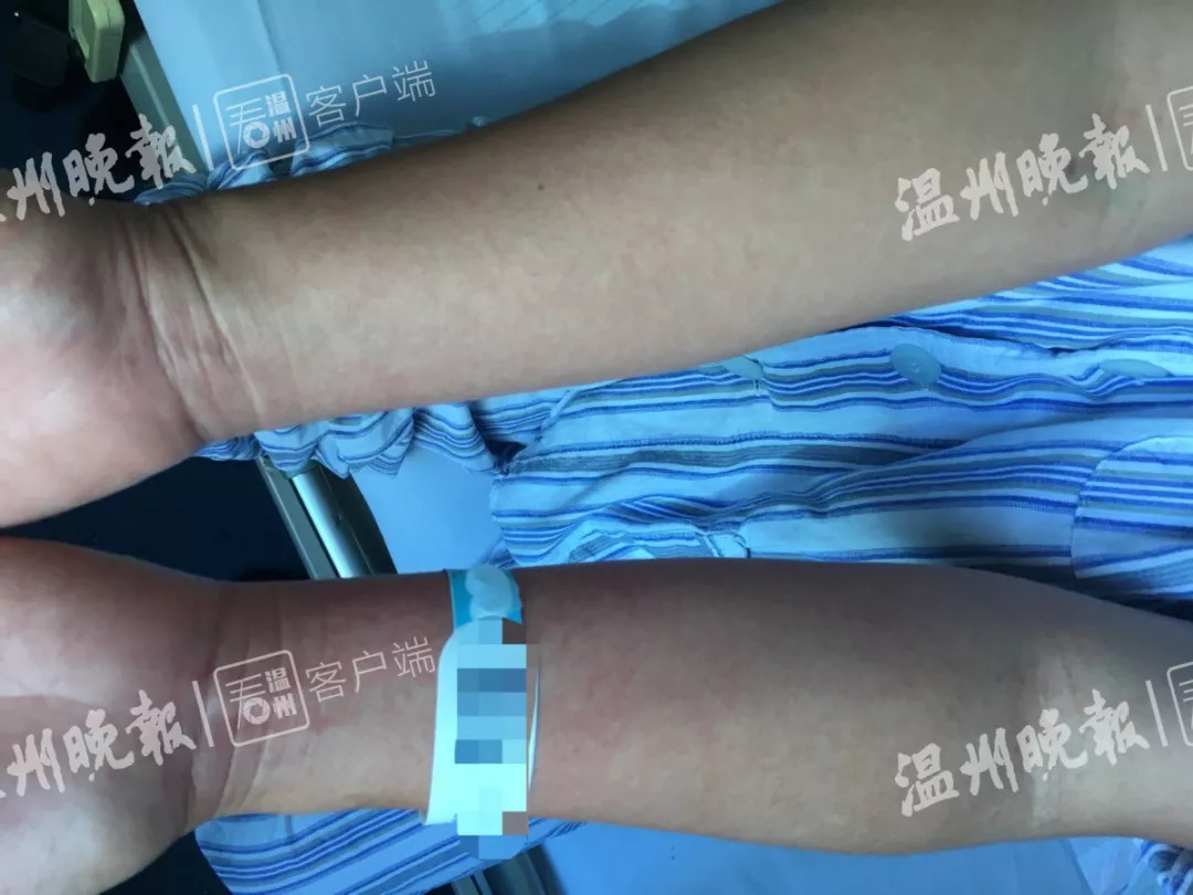 去泰国旅游后发高烧,泰国旅游回来得了罕见病