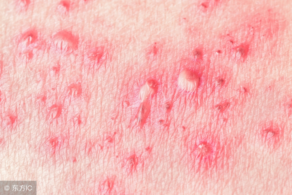 单纯疱疹的症状表现有哪些,一型单纯疱疹和二型单纯疱疹