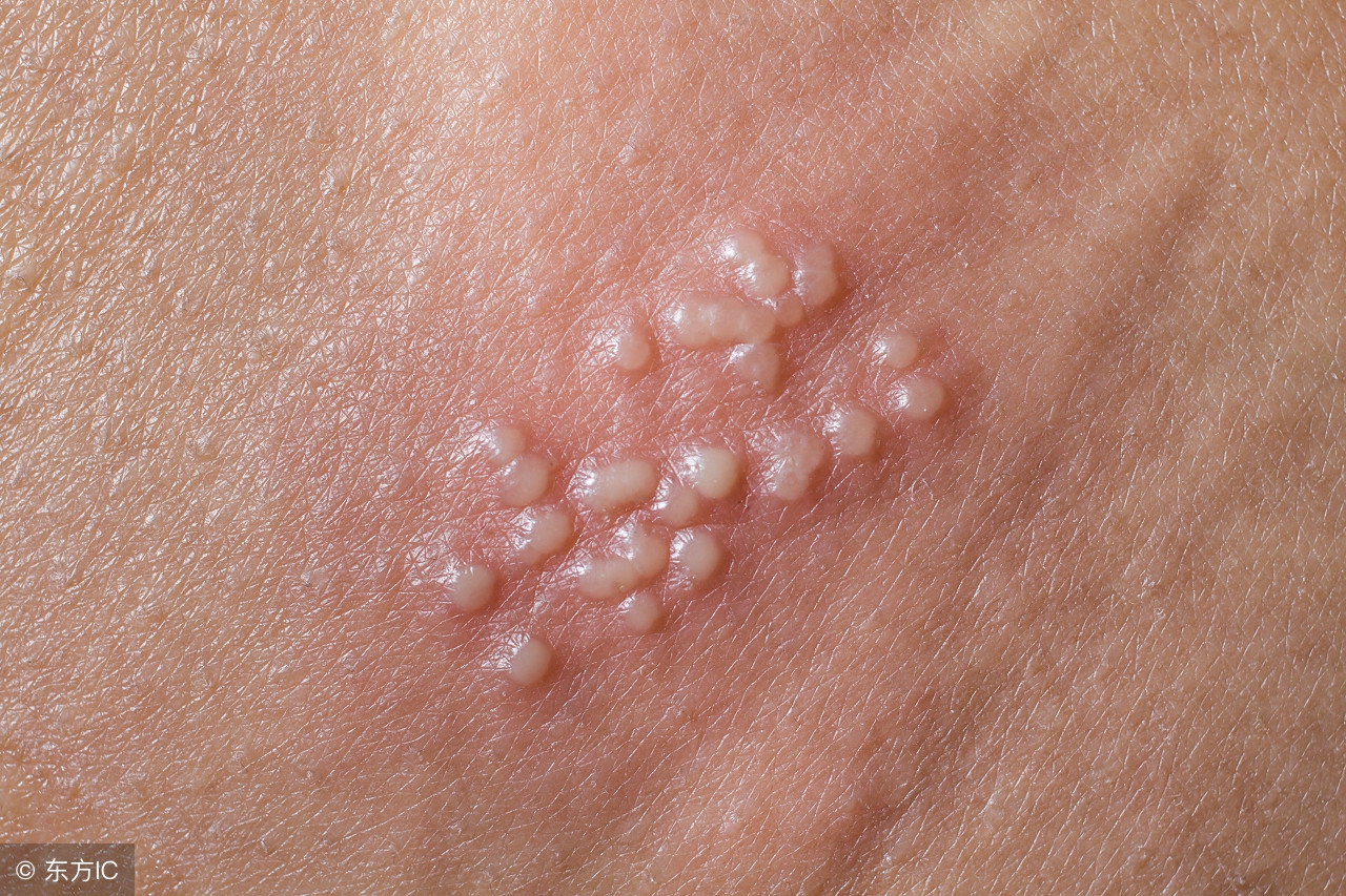 单纯疱疹的症状表现有哪些,一型单纯疱疹和二型单纯疱疹