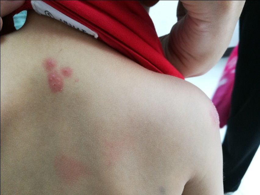 带状疱疹自愈要多久,带状疱疹症状和表现