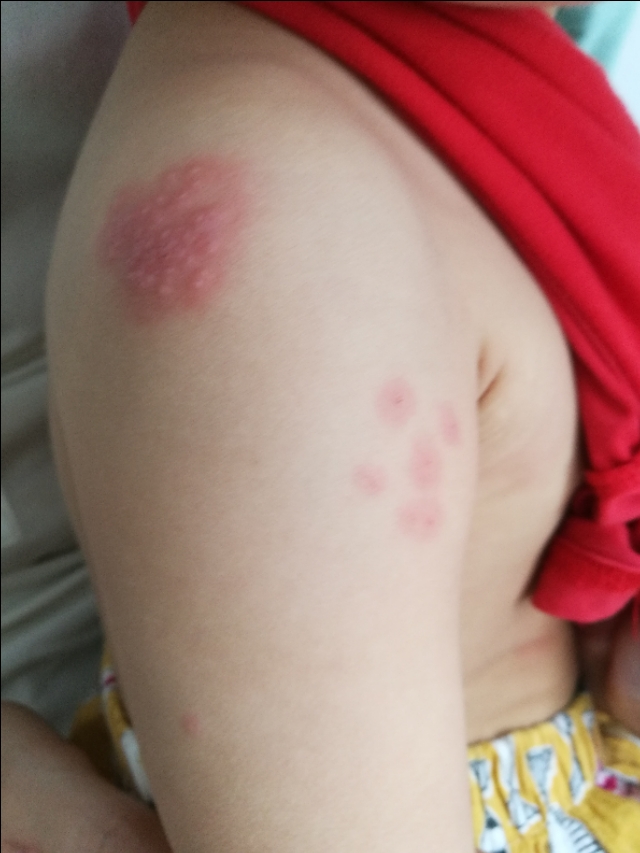 带状疱疹自愈要多久,带状疱疹症状和表现