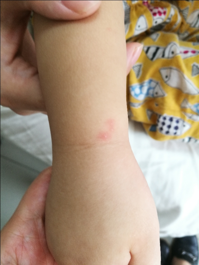 带状疱疹自愈要多久,带状疱疹症状和表现