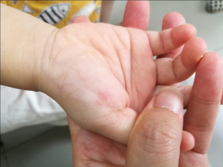 带状疱疹自愈要多久,带状疱疹症状和表现