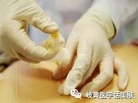 「杏林微科普」带您了解:中医穴位埋线
