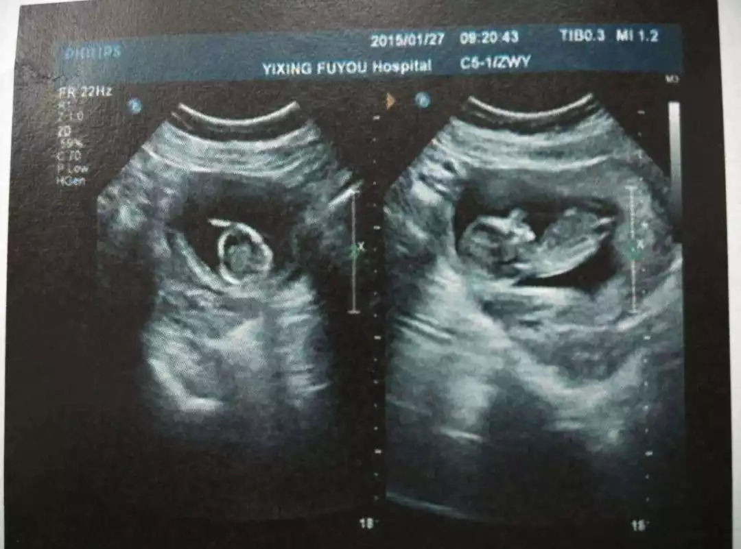 流产之际，28岁广州妈妈用了这一招，住院98天后成功救回宝宝