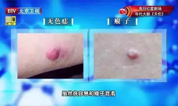 这四种痣会癌变赶紧来了解一下,这5种癌及早发现同样能治愈