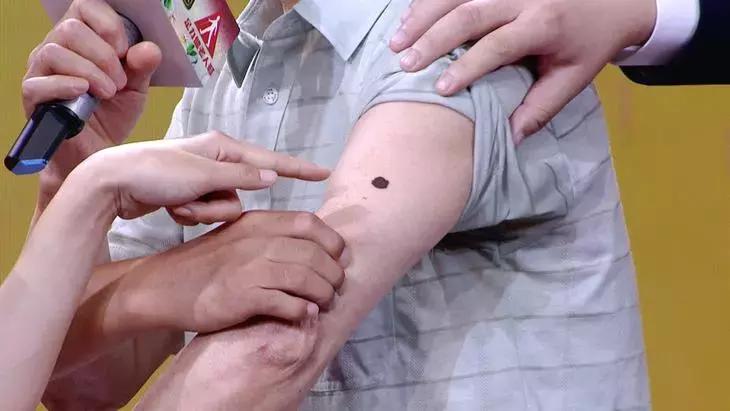 这四种痣会癌变赶紧来了解一下,这5种癌及早发现同样能治愈