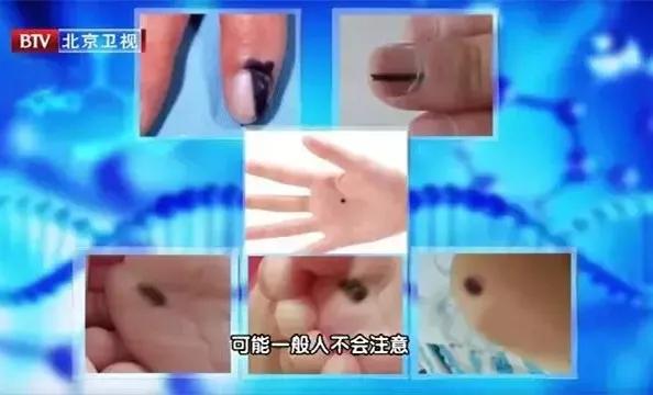 这四种痣会癌变赶紧来了解一下,这5种癌及早发现同样能治愈