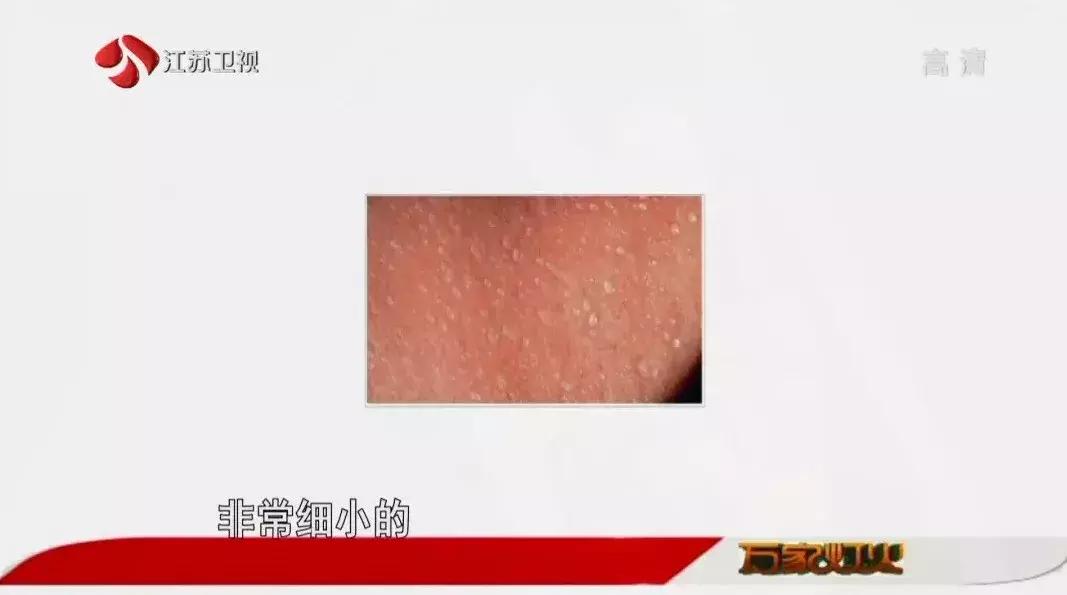 季节过敏性皮肤病怎么办,皮肤科湿疹什么季节容易犯