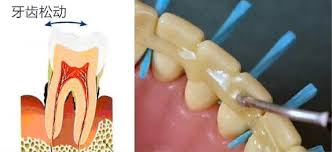 牙齿松动到什么程度可以拔牙,松动的牙可以用牙套固定吗