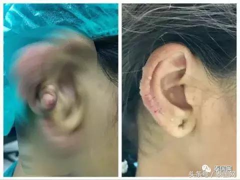 泰国女人打耳洞视频,泰国女子打耳洞