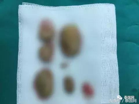 泰国女人打耳洞视频,泰国女子打耳洞