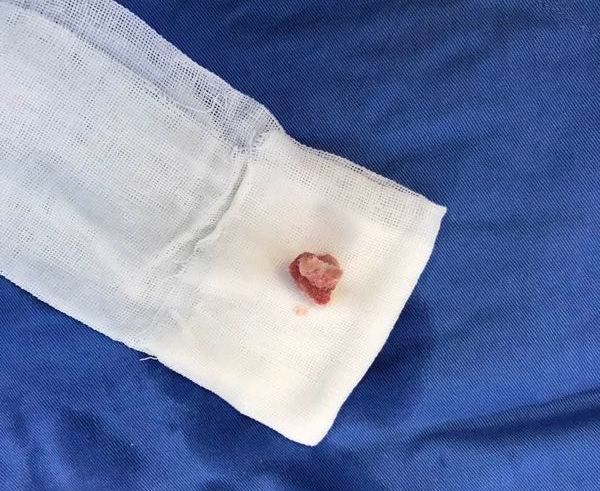 4岁女孩患阴道炎，医生竟从她阴道里取出这东西