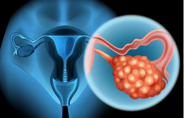 女人这里忽然变粗，十有八九是卵巢癌在作怪，最好尽早去检查