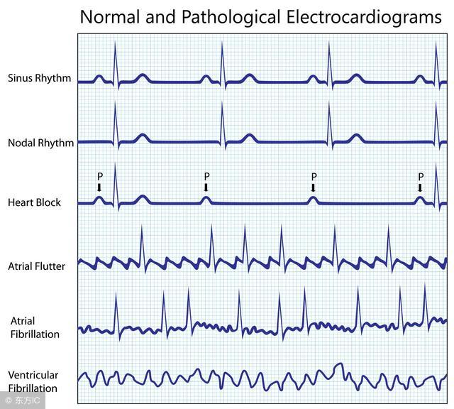 对于房颤的患者该怎么治疗,治疗房颤有什么新方法吗