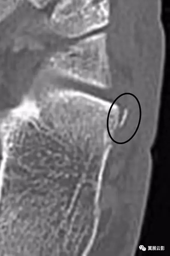 跟骨误诊,影像学误诊