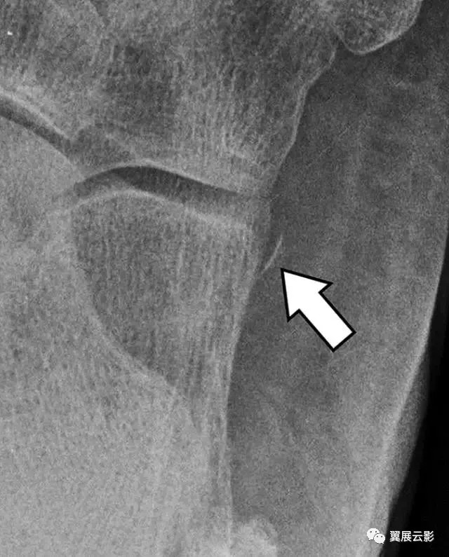 跟骨误诊,影像学误诊