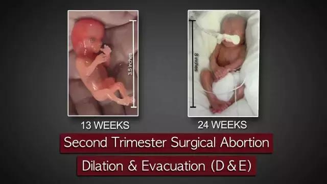 堕胎是杀人吗,堕胎就是杀生