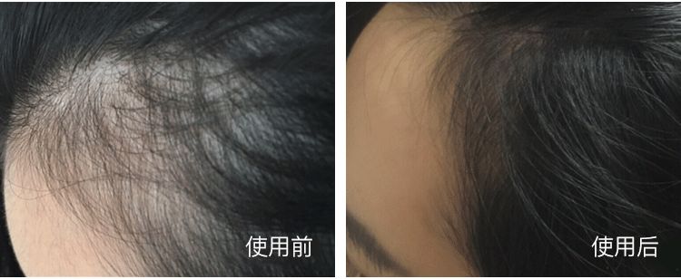 网红都在穿的矫正驼背内衣,能解决驼背的内衣