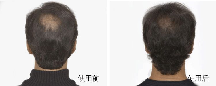 网红都在穿的矫正驼背内衣,能解决驼背的内衣