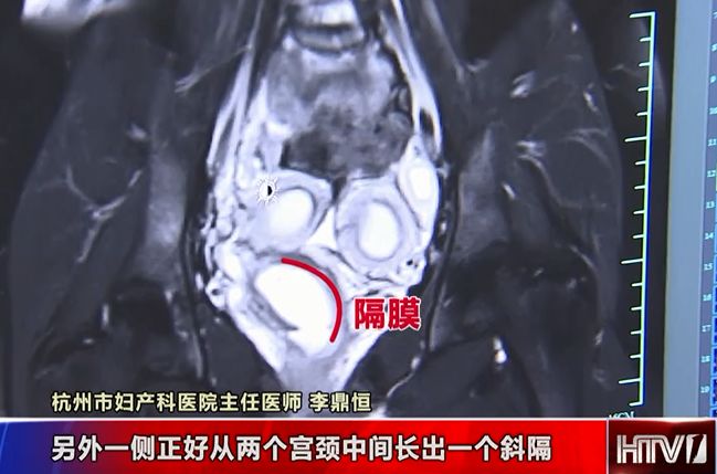 杭州一女孩痛经反复，经检查发现竟得了这个！看看你有没有这些误区……