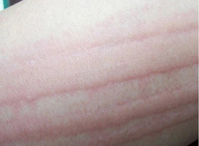 挠痒起风团,过敏性荨麻疹太刺挠了怎么办