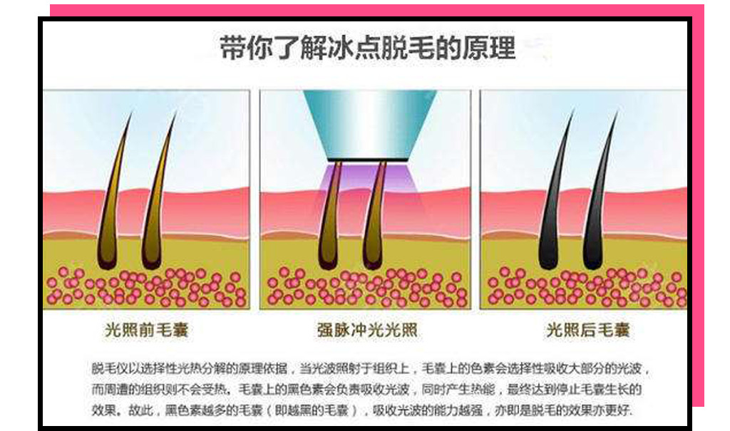 蜜蜡脱毛能不能先涂一层脱毛膏,脱毛膏刮毛刀镊子拔毛