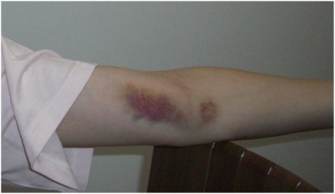 有些人的身体总是无缘无故出现淤青是怎么回事?得了什么病?