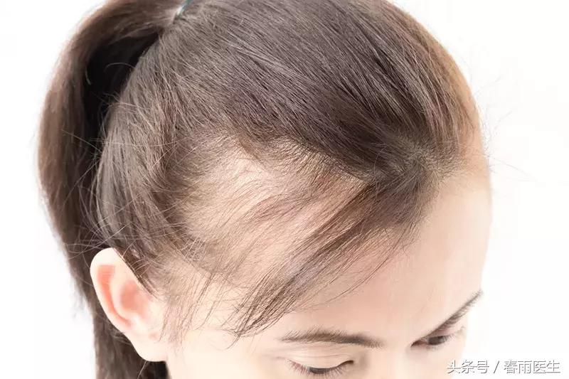 开始秃头有得治吗,年纪轻轻秃头是因为什么
