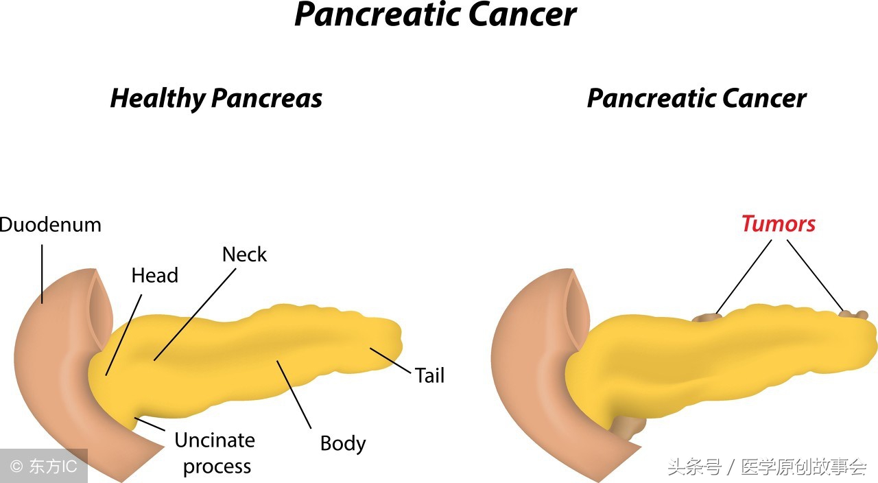 乔布斯从查出胰腺癌到死亡多久,乔布斯确诊胰腺癌后生存几年