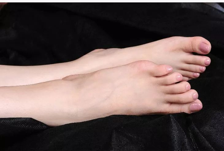 香港脚气最好的治疗方法,香港脚怎么彻底治愈