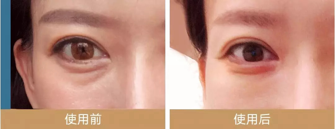 眼贴去眼袋的眼膜推荐平价,民间去眼袋最好的眼膜