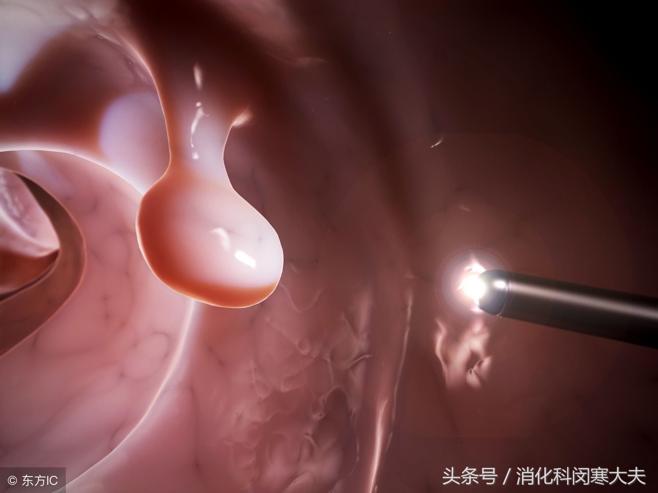 肠息肉复查连续3年都复发严重吗,胃肠息肉切除后防止复发三大忌