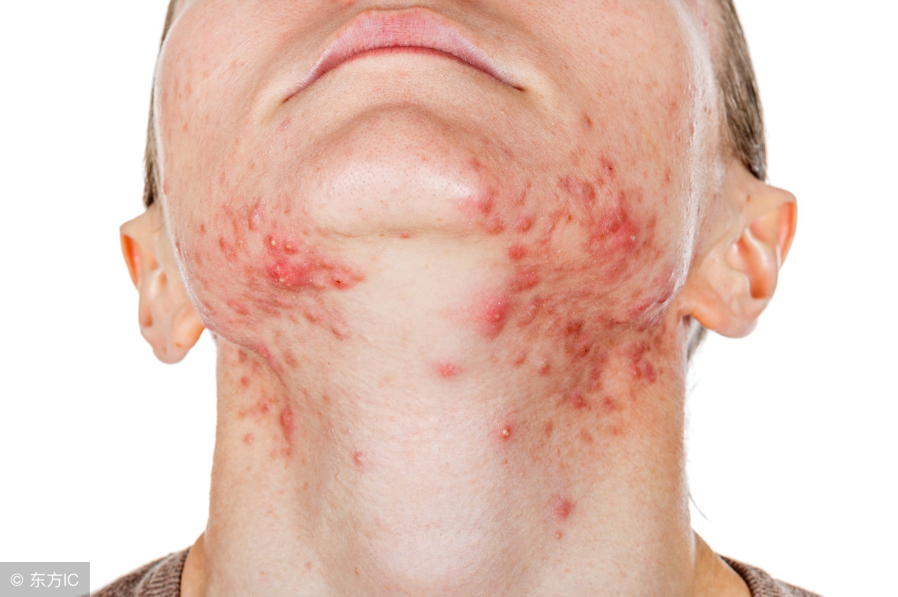 一片叶子搞定螨虫,床上的螨虫能彻底清除吗